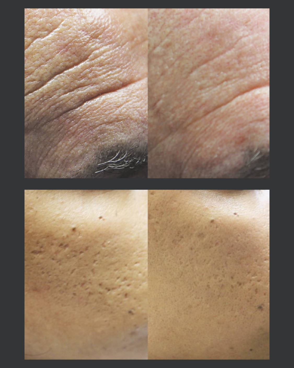 Before & After FeatherTouch™